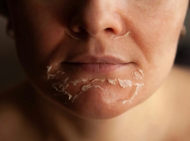 O que causa pele seca? Chuveiros quentes