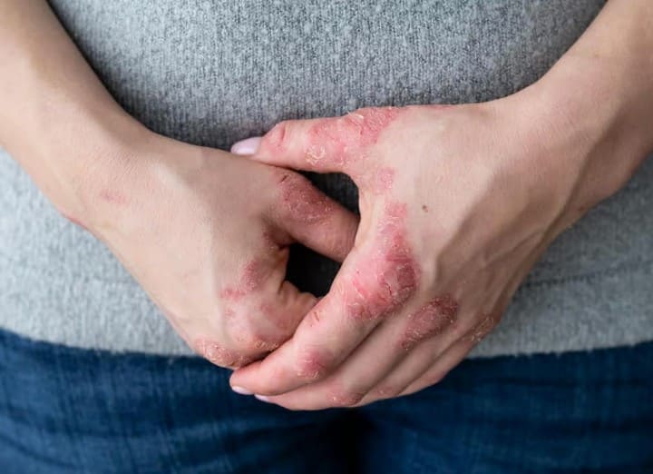 Queimadura Elétrica